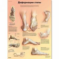 Плакат Деформация стопы