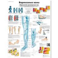 Плакат  Варикозные вены, плакат, размер 50х67 см