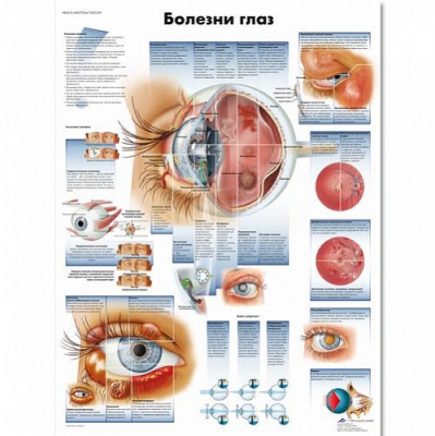 Плакат  Болезни глаз