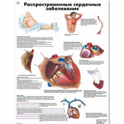 Плакат  Распространенные сердечные заболевания